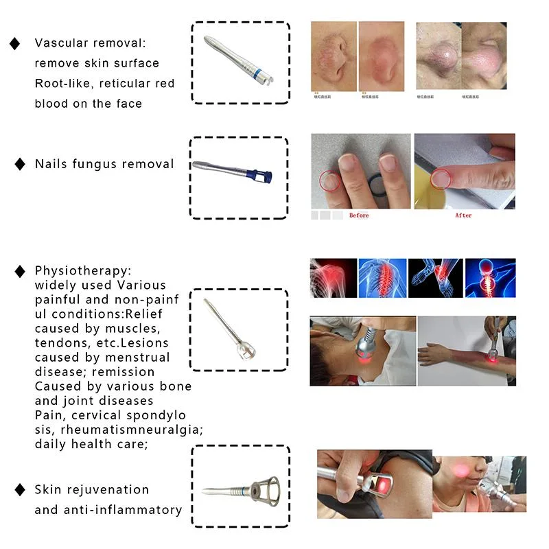 980nm 1470nm Diode Laser Hemorrhoids Surgery Skin/Evlt/Pldd/Dental Laser